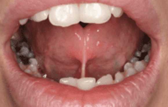 dinh-thang-luoi-o-nguoi-lon Ngắn Lưỡi Ở Người Lớn: Khi Nào Cần Điều Trị Và Phẫu Thuật Cắt Thắng Lưỡi?