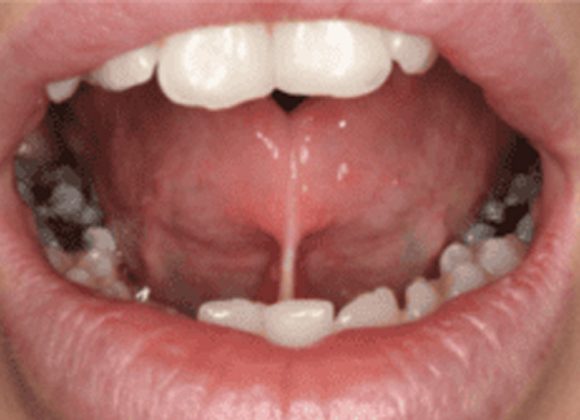 Ngắn Lưỡi Ở Người Lớn: Khi Nào Cần Điều Trị Và Phẫu Thuật Cắt Thắng Lưỡi?